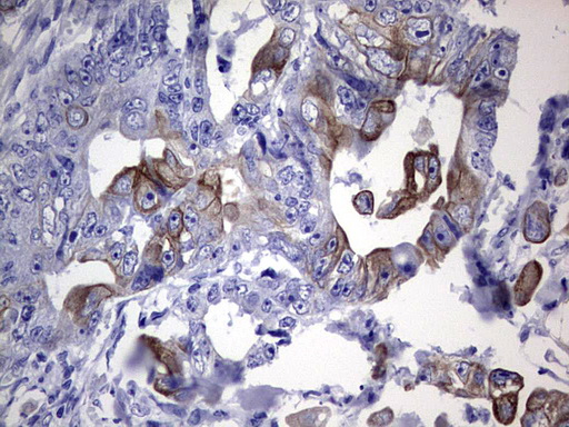KRT19 / CK19 / Cytokeratin 19 Antibody - Immunohistochemical staining of paraffin-embedded Adenocarcinoma of Human colon tissue using anti-KRT19 mouse monoclonal antibody. (Heat-induced epitope retrieval by 1 mM EDTA in 10mM Tris, pH8.5, 120C for 3min,