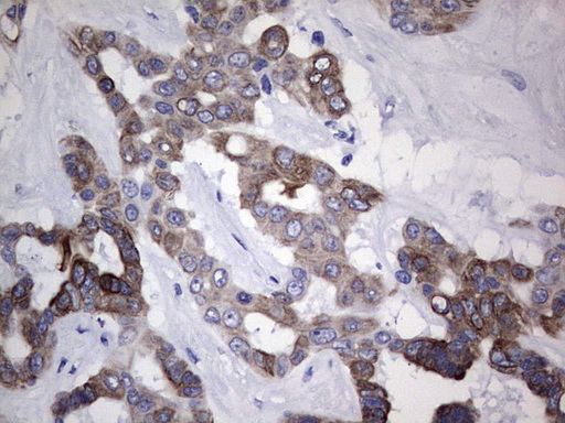 KRT19 / CK19 / Cytokeratin 19 Antibody - Immunohistochemical staining of paraffin-embedded Carcinoma of Human liver tissue using anti-KRT19 mouse monoclonal antibody. (Heat-induced epitope retrieval by 1 mM EDTA in 10mM Tris, pH8.5, 120C for 3min,