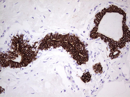 KRT19 / CK19 / Cytokeratin 19 Antibody - Immunohistochemical staining of paraffin-embedded Adenocarcinoma of Human breast tissue using anti-KRT19 mouse monoclonal antibody. (Heat-induced epitope retrieval by 1mM EDTA in 10mM Tris buffer. (pH9.0) at 120C for 3 min. (1:200)