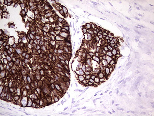 KRT19 / CK19 / Cytokeratin 19 Antibody - Immunohistochemical staining of paraffin-embedded Carcinoma of Human kidney tissue using anti-KRT19 mouse monoclonal antibody. (Heat-induced epitope retrieval by 1mM EDTA in 10mM Tris buffer. (pH9.0) at 120C for 3 min. (1:200)