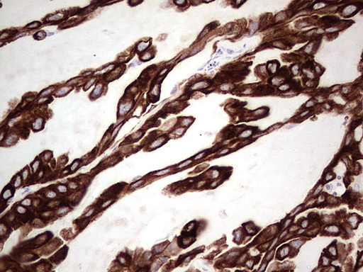 KRT19 / CK19 / Cytokeratin 19 Antibody - Immunohistochemical staining of paraffin-embedded Carcinoma of Human lung tissue using anti-KRT19 mouse monoclonal antibody. (Heat-induced epitope retrieval by 1mM EDTA in 10mM Tris buffer. (pH9.0) at 120C for 3 min. (1:200)