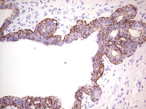 KRT19 / CK19 / Cytokeratin 19 Antibody - Immunohistochemical staining of paraffin-embedded Carcinoma of Human prostate tissue using anti-KRT19 mouse monoclonal antibody. (Heat-induced epitope retrieval by 1mM EDTA in 10mM Tris buffer. (pH9.0) at 120C for 3 min. (1:200)
