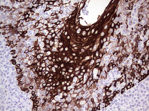 KRT19 / CK19 / Cytokeratin 19 Antibody - Immunohistochemical staining of paraffin-embedded Human tonsil using anti-KRT19 mouse monoclonal antibody. (Heat-induced epitope retrieval by 1mM EDTA in 10mM Tris buffer. (pH9.0) at 120C for 3 min. (1:200)