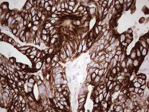 KRT19 / CK19 / Cytokeratin 19 Antibody - Immunohistochemical staining of paraffin-embedded Adenocarcinoma of Human colon tissue using anti-KRT19 mouse monoclonal antibody. (Heat-induced epitope retrieval by 1mM EDTA in 10mM Tris buffer. (pH9.0) at 120C for 3 min. (1:200)