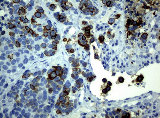 KRT19 / CK19 / Cytokeratin 19 Antibody - Immunohistochemical staining of paraffin-embedded Carcinoma of lung tissue using anti-KRT19mouse monoclonal antibody. (Clone UMAB2, dilution 1:100; heat-induced epitope retrieval by 10mM citric buffer, pH6.0, 120C for 3min)