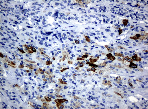 KRT19 / CK19 / Cytokeratin 19 Antibody - Immunohistochemical staining of paraffin-embedded Carcinoma of thyroid tissue using anti-KRT19mouse monoclonal antibody. (Clone UMAB2, dilution 1:100; heat-induced epitope retrieval by 10mM citric buffer, pH6.0, 120C for 3min)