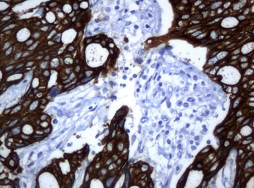 KRT19 / CK19 / Cytokeratin 19 Antibody - Immunohistochemical staining of paraffin-embedded Adenocarcinoma of breast tissue using anti-KRT19 mouse monoclonal antibody. (Clone UMAB2, dilution 1:100; heat-induced epitope retrieval by 10mM citric buffer, pH6.0, 120C for 3min)