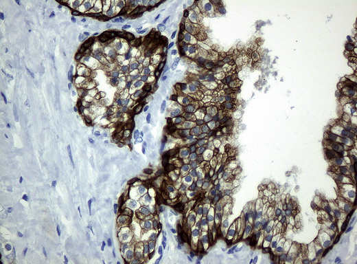 KRT19 / CK19 / Cytokeratin 19 Antibody - Immunohistochemical staining of paraffin-embedded Carcinoma of prostate tissue using anti-KRT19mouse monoclonal antibody. (Clone UMAB2, dilution 1:100; heat-induced epitope retrieval by 10mM citric buffer, pH6.0, 120C for 3min)