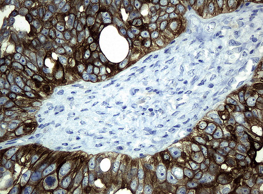 KRT19 / CK19 / Cytokeratin 19 Antibody - Immunohistochemical staining of paraffin-embedded Adenocarcinoma of ovary tissue using anti-KRT19mouse monoclonal antibody. (Clone UMAB2, dilution 1:100; heat-induced epitope retrieval by 10mM citric buffer, pH6.0, 120C for 3min)