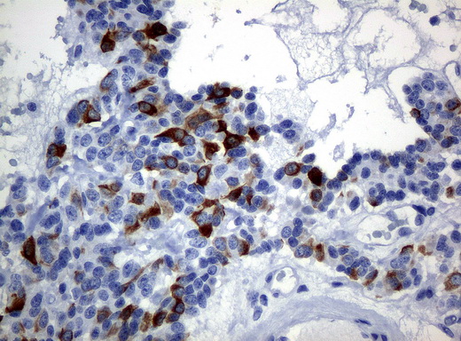 KRT19 / CK19 / Cytokeratin 19 Antibody - Immunohistochemical staining of paraffin-embedded Carcinoma of pancreas tissue using anti-KRT19mouse monoclonal antibody. (Clone UMAB2, dilution 1:100; heat-induced epitope retrieval by 10mM citric buffer, pH6.0, 120C for 3min)