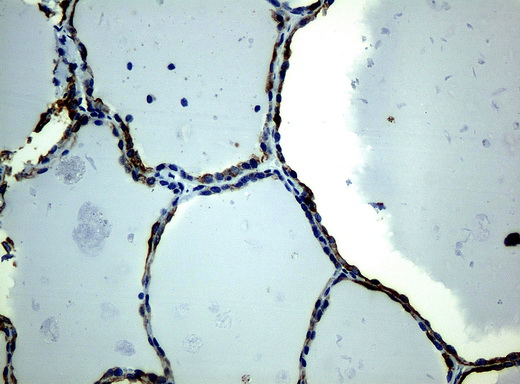 KRT19 / CK19 / Cytokeratin 19 Antibody - Immunohistochemical staining of paraffin-embedded thyroid tissue using anti-KRT19mouse monoclonal antibody. (Clone UMAB2, dilution 1:100; heat-induced epitope retrieval by 10mM citric buffer, pH6.0, 120C for 3min)