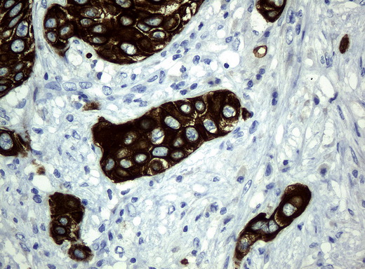 KRT19 / CK19 / Cytokeratin 19 Antibody - Immunohistochemical staining of paraffin-embedded Carcinoma of bladder tissue using anti-KRT19mouse monoclonal antibody. (Clone UMAB2, dilution 1:100; heat-induced epitope retrieval by 10mM citric buffer, pH6.0, 120C for 3min)