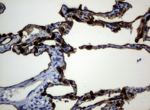 KRT19 / CK19 / Cytokeratin 19 Antibody - Immunohistochemical staining of paraffin-embedded lung tissue using anti-KRT19mouse monoclonal antibody. (Clone UMAB2, dilution 1:100; heat-induced epitope retrieval by 10mM citric buffer, pH6.0, 120C for 3min)