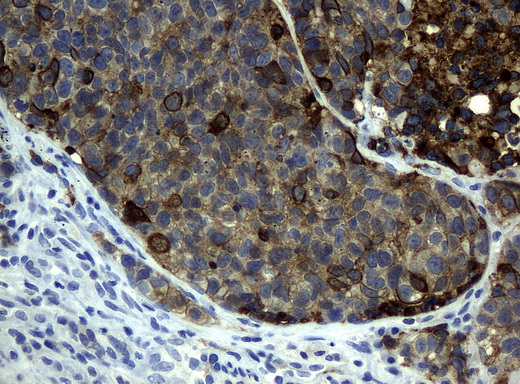 KRT19 / CK19 / Cytokeratin 19 Antibody - Immunohistochemical staining of paraffin-embedded Carcinoma of lung tissue using anti-KRT19mouse monoclonal antibody. (Clone UMAB3, dilution 1:100; heat-induced epitope retrieval by 10mM citric buffer, pH6.0, 120C for 3min)