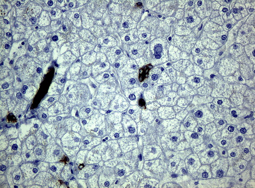 KRT19 / CK19 / Cytokeratin 19 Antibody - Immunohistochemical staining of paraffin-embedded liver tissue using anti-KRT19mouse monoclonal antibody. (Clone UMAB3, dilution 1:100; heat-induced epitope retrieval by 10mM citric buffer, pH6.0, 120C for 3min)