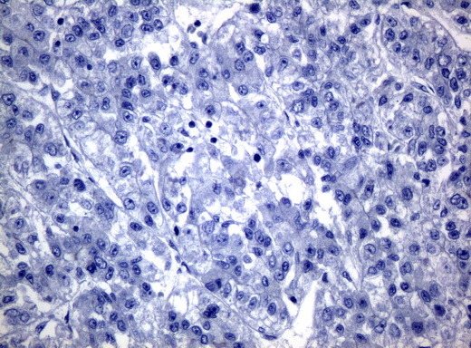KRT19 / CK19 / Cytokeratin 19 Antibody - Immunohistochemical staining of paraffin-embedded Carcinoma of liver tissue using anti-KRT19mouse monoclonal antibody. (Clone UMAB3, dilution 1:100; heat-induced epitope retrieval by 10mM citric buffer, pH6.0, 120C for 3min)