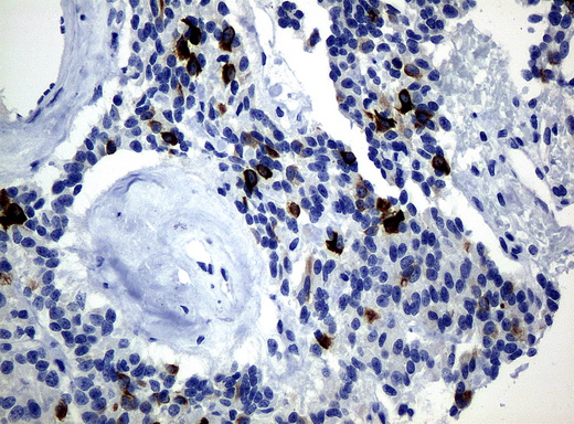 KRT19 / CK19 / Cytokeratin 19 Antibody - Immunohistochemical staining of paraffin-embedded Carcinoma of pancreas tissue using anti-KRT19mouse monoclonal antibody. (Clone UMAB3, dilution 1:100; heat-induced epitope retrieval by 10mM citric buffer, pH6.0, 120C for 3min)