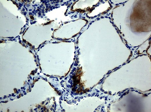 KRT19 / CK19 / Cytokeratin 19 Antibody - Immunohistochemical staining of paraffin-embedded thyroid tissue using anti-KRT19mouse monoclonal antibody. (Clone UMAB3, dilution 1:100; heat-induced epitope retrieval by 10mM citric buffer, pH6.0, 120C for 3min)