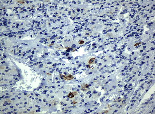 KRT19 / CK19 / Cytokeratin 19 Antibody - Immunohistochemical staining of paraffin-embedded Carcinoma of thyroid tissue using anti-KRT19mouse monoclonal antibody. (Clone UMAB3, dilution 1:100; heat-induced epitope retrieval by 10mM citric buffer, pH6.0, 120C for 3min)