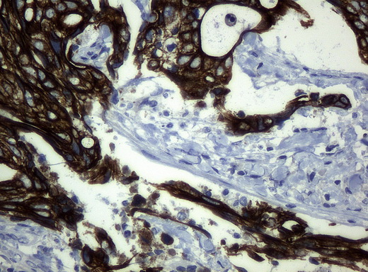 KRT19 / CK19 / Cytokeratin 19 Antibody - Immunohistochemical staining of paraffin-embedded Adenocarcinoma of breast tissue using anti-KRT19 mouse monoclonal antibody. (Clone UMAB3, dilution 1:100; heat-induced epitope retrieval by 10mM citric buffer, pH6.0, 120C for 3min)