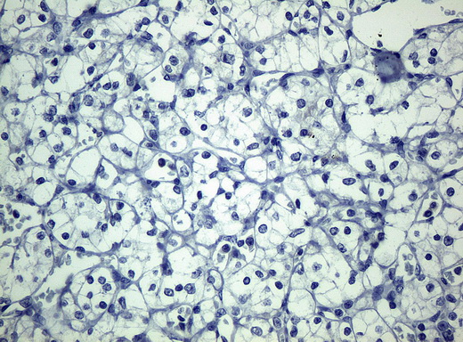 KRT19 / CK19 / Cytokeratin 19 Antibody - Immunohistochemical staining of paraffin-embedded Carcinoma of kidney tissue using anti-KRT19mouse monoclonal antibody. (Clone UMAB3, dilution 1:100; heat-induced epitope retrieval by 10mM citric buffer, pH6.0, 120C for 3min)