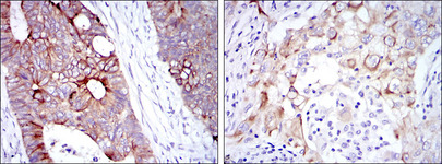 KRT19 / CK19 / Cytokeratin 19 Antibody - IHC of paraffin-embedded rectum cancer tissues (left) and lung cancer tissues (right) using KRT19 mouse monoclonal antibody with DAB staining.