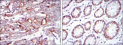 KRT19 / CK19 / Cytokeratin 19 Antibody - IHC of paraffin-embedded stomach cancer tissues (left) and stomach tissues (right) using KRT19 mouse monoclonal antibody with DAB staining.
