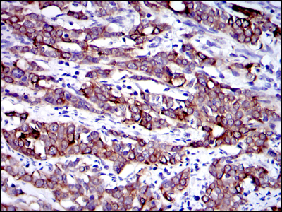 KRT19 / CK19 / Cytokeratin 19 Antibody - IHC of paraffin-embedded human cervical cancer tissues using KRT19 mouse monoclonal antibody with DAB staining.