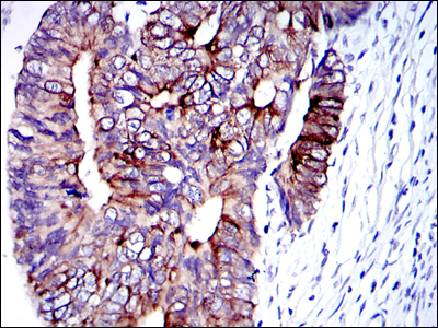 KRT19 / CK19 / Cytokeratin 19 Antibody - IHC of paraffin-embedded human colon cancer tissues using KRT19 mouse monoclonal antibody with DAB staining.