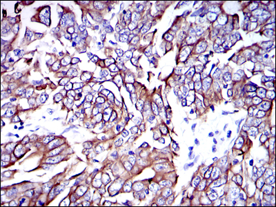 KRT19 / CK19 / Cytokeratin 19 Antibody - IHC of paraffin-embedded human stomach cancer tissues using KRT19 mouse monoclonal antibody with DAB staining.