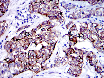 KRT19 / CK19 / Cytokeratin 19 Antibody - IHC of paraffin-embedded human bladder cancer tissues using KRT19 mouse monoclonal antibody with DAB staining.
