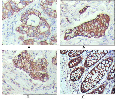 KRT19 / CK19 / Cytokeratin 19 Antibody - IHC of paraffin-embedded human breast carcinoma(A), lung cancer(B) and normal colon tissue(C), showing cytoplasmic localization with DAB staining using KRT19 mouse monoclonal antibody.