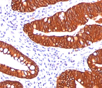 KRT19 / CK19 / Cytokeratin 19 Antibody - Cytokeratin 19 antibody A53-B/A2.26 immunohistochemistry colon cancer.  This image was taken for the unmodified form of this product. Other forms have not been tested.