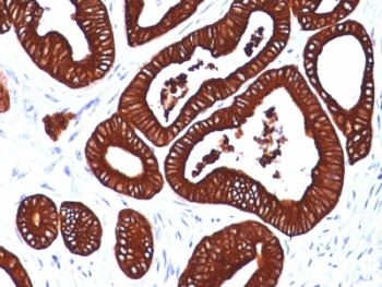 KRT19 / CK19 / Cytokeratin 19 Antibody - Formalin-fixed, paraffin-embedded human colon carcinoma stained with Keratin 19 antibody (BA17).  This image was taken for the unmodified form of this product. Other forms have not been tested.
