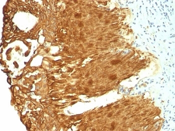 KRT19 / CK19 / Cytokeratin 19 Antibody - Formalin-fixed, paraffin-embedded human cervical carcinoma stained with Cytokeratin 19 antibody (KRT19/799 + KRT19/800).  This image was taken for the unmodified form of this product. Other forms have not been tested.