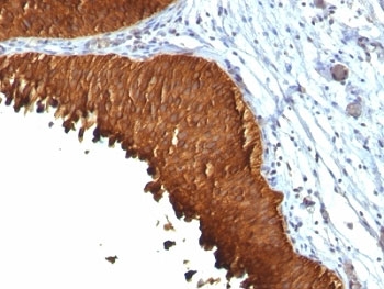 KRT19 / CK19 / Cytokeratin 19 Antibody - Formalin-fixed, paraffin-embedded human bladder carcinoma stained with Cytokeratin 19 antibody (KRT19/799 + KRT19/800).  This image was taken for the unmodified form of this product. Other forms have not been tested.