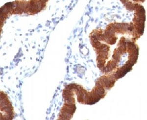 KRT19 / CK19 / Cytokeratin 19 Antibody - Formalin-fixed, paraffin-embedded human ovarian carcinoma stained with Cytokeratin 19 antibody (KRT19/799 + KRT19/800).  This image was taken for the unmodified form of this product. Other forms have not been tested.