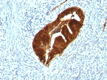 KRT19 / CK19 / Cytokeratin 19 Antibody - Formalin-fixed, paraffin-embedded human endometrial carcinoma stained with Cytokeratin 19 antibody (KRT19/799 + KRT19/800).  This image was taken for the unmodified form of this product. Other forms have not been tested.