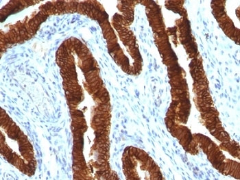 KRT19 / CK19 / Cytokeratin 19 Antibody - Formalin-fixed, paraffin-embedded human ovarian carcinoma stained with CK19 antibody (KRT19/800).  This image was taken for the unmodified form of this product. Other forms have not been tested.