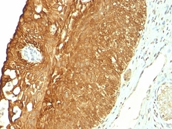 KRT19 / CK19 / Cytokeratin 19 Antibody - Formalin-fixed, paraffin-embedded human cervical carcinoma stained with CK19 antibody (KRT19/800).  This image was taken for the unmodified form of this product. Other forms have not been tested.