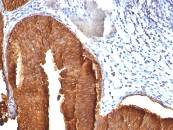 KRT19 / CK19 / Cytokeratin 19 Antibody - Formalin-fixed, paraffin-embedded human bladder carcinoma stained with CK19 antibody (KRT19/800).  This image was taken for the unmodified form of this product. Other forms have not been tested.