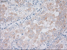 KRT19 / CK19 / Cytokeratin 19 Antibody - IHC of paraffin-embedded Carcinoma of kidney tissue using anti-KRT19 mouse monoclonal antibody. (Dilution 1:50).