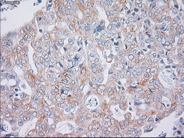 KRT19 / CK19 / Cytokeratin 19 Antibody - IHC of paraffin-embedded Carcinoma of liver tissue using anti-KRT19 mouse monoclonal antibody. (Dilution 1:50).
