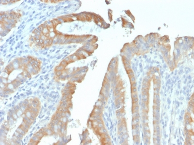 KRT19 / CK19 / Cytokeratin 19 Antibody - Formalin-fixed, paraffin-embedded human Colon Carcinoma stained with Cytokeratin 19 Mouse Recombinant Monoclonal Antibody (rKRT19/799).