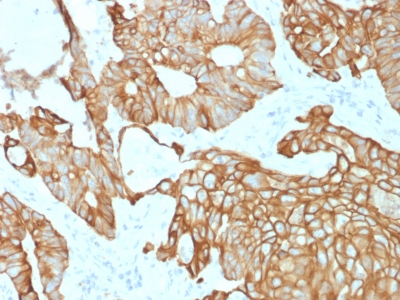 KRT19 / CK19 / Cytokeratin 19 Antibody - Formalin-fixed, paraffin-embedded human Colon Carcinoma stained with CK19 Mouse Recombinant Monoclonal Antibody (rKRT19/800).