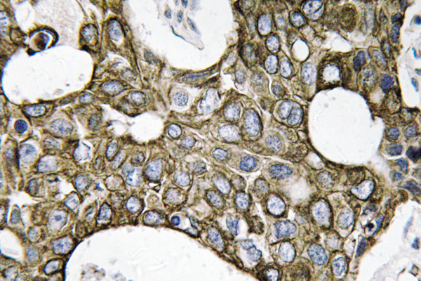 KRT19 / CK19 / Cytokeratin 19 Antibody - IHC of Cytokeratin19 (L349) pAb in paraffin-embedded human breast carcinoma tissue.