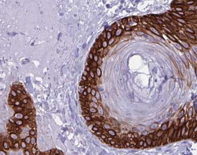 KRT19 / CK19 / Cytokeratin 19 Antibody - 1:500 staining human colon carcinoma tissue by IHC-P. The tissue was formaldehyde fixed and a heat mediated antigen retrieval step in citrate buffer was performed. The tissue was then blocked and incubated with the antibody for 1.5 hours at 22°C. An HRP conjugated goat anti-rabbit antibody was used as the secondary.