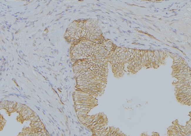 KRT19 / CK19 / Cytokeratin 19 Antibody - 1:100 staining human colon carcinoma tissue by IHC-P. The sample was formaldehyde fixed and a heat mediated antigen retrieval step in citrate buffer was performed. The sample was then blocked and incubated with the antibody for 1.5 hours at 22°C. An HRP conjugated goat anti-rabbit antibody was used as the secondary.