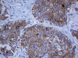 KRT20 / CK20 / Cytokeratin 20 Antibody - IHC of paraffin-embedded Carcinoma of Human lung tissue using anti-KRT20 mouse monoclonal antibody.