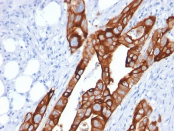 KRT20 / CK20 / Cytokeratin 20 Antibody - IHC testing of human colon carcinoma with Cytokeratin 20 antibody (clone KRT20/1991). Required HIER: boil tissue sections in 10mM citrate buffer, pH 6, for 10-20 min followed by cooling at RT for 20 min.